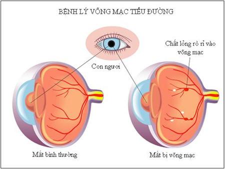 Biến chứng mắt 