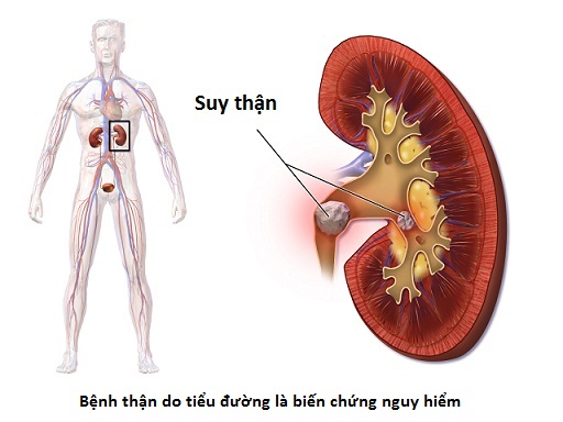 Biến chứng thận do bệnh tiểu đường